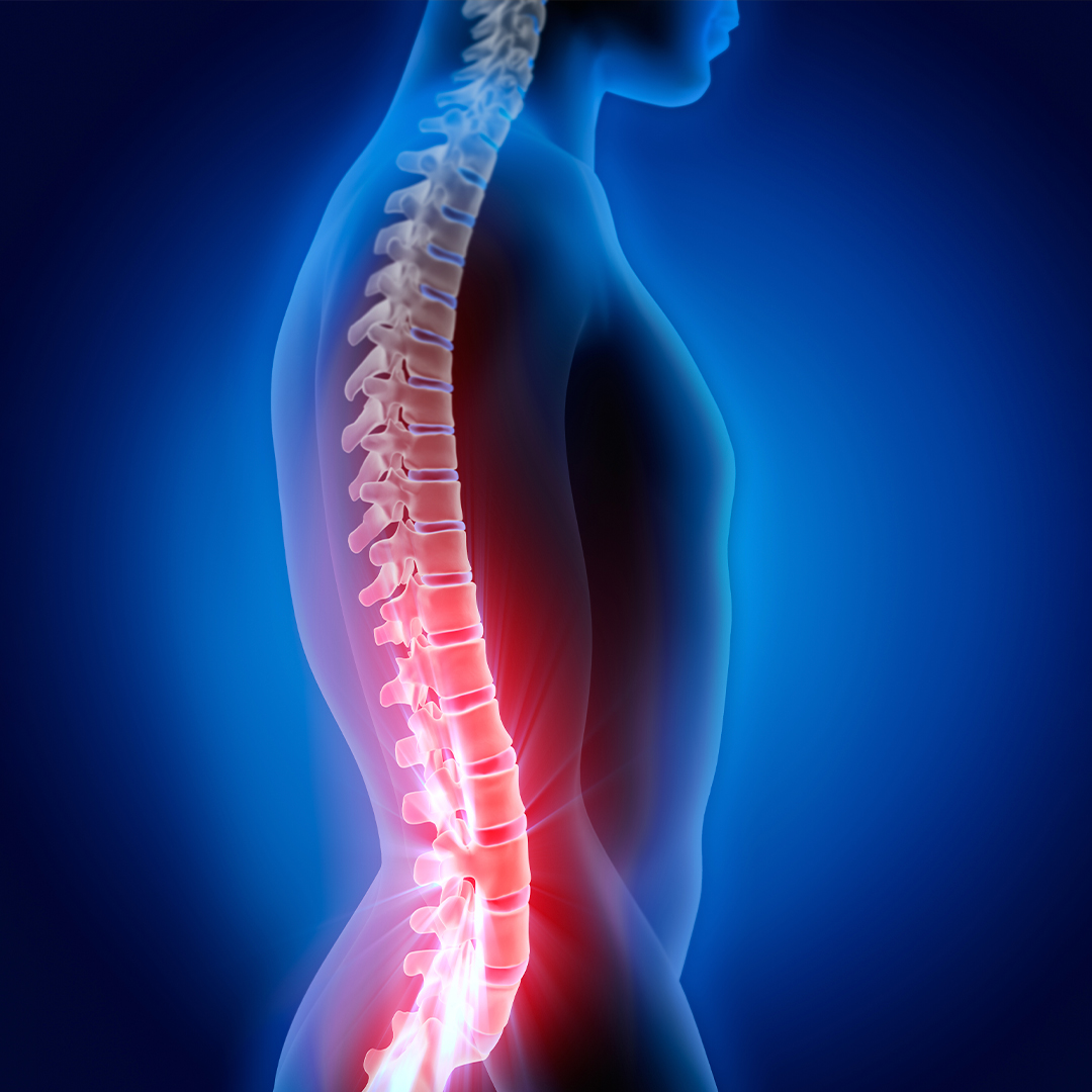 FDA Approves Senza®, Nevro's High Frequency Spinal Cord