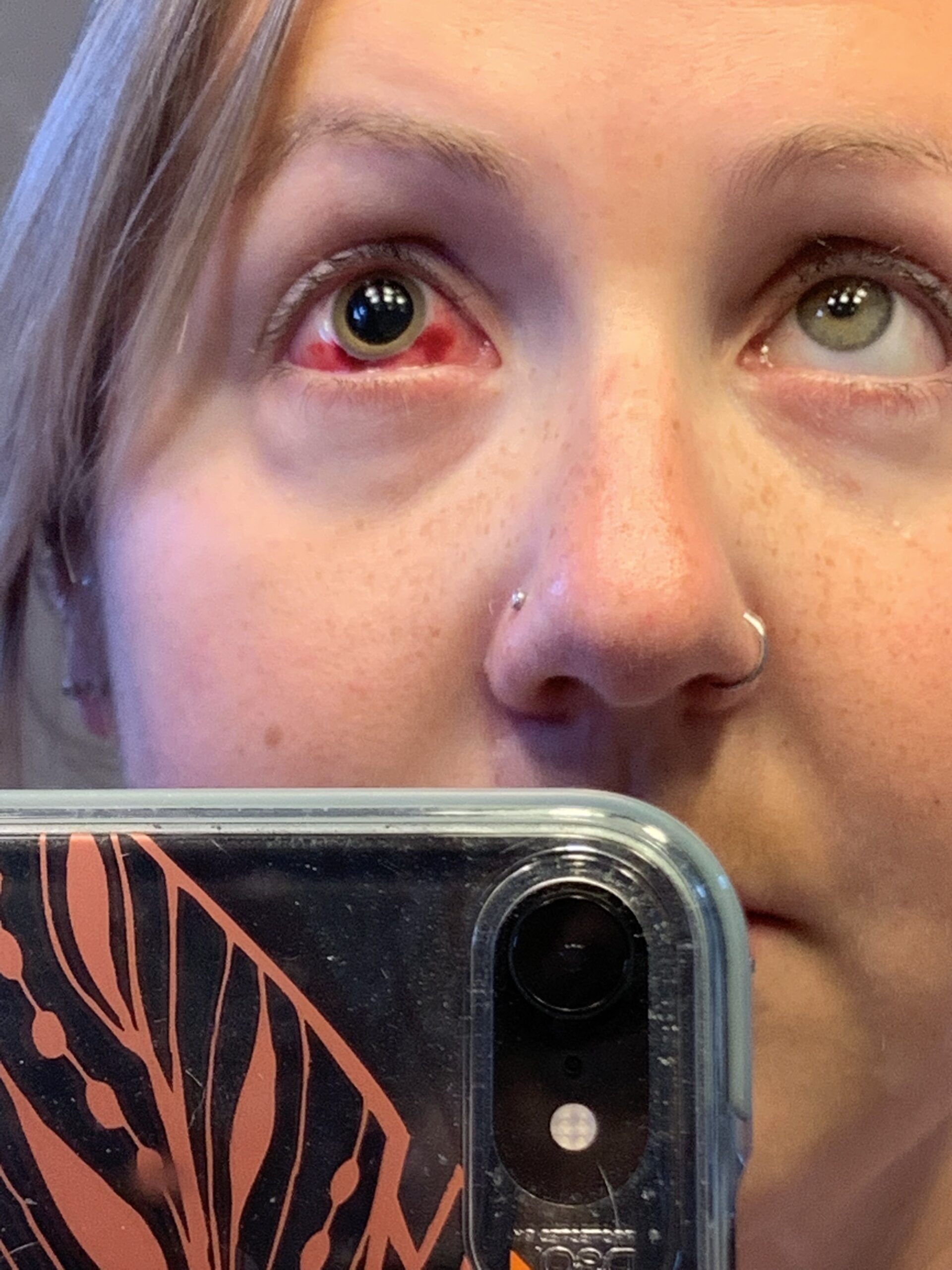 Rachael's story: diabetic retinopathy