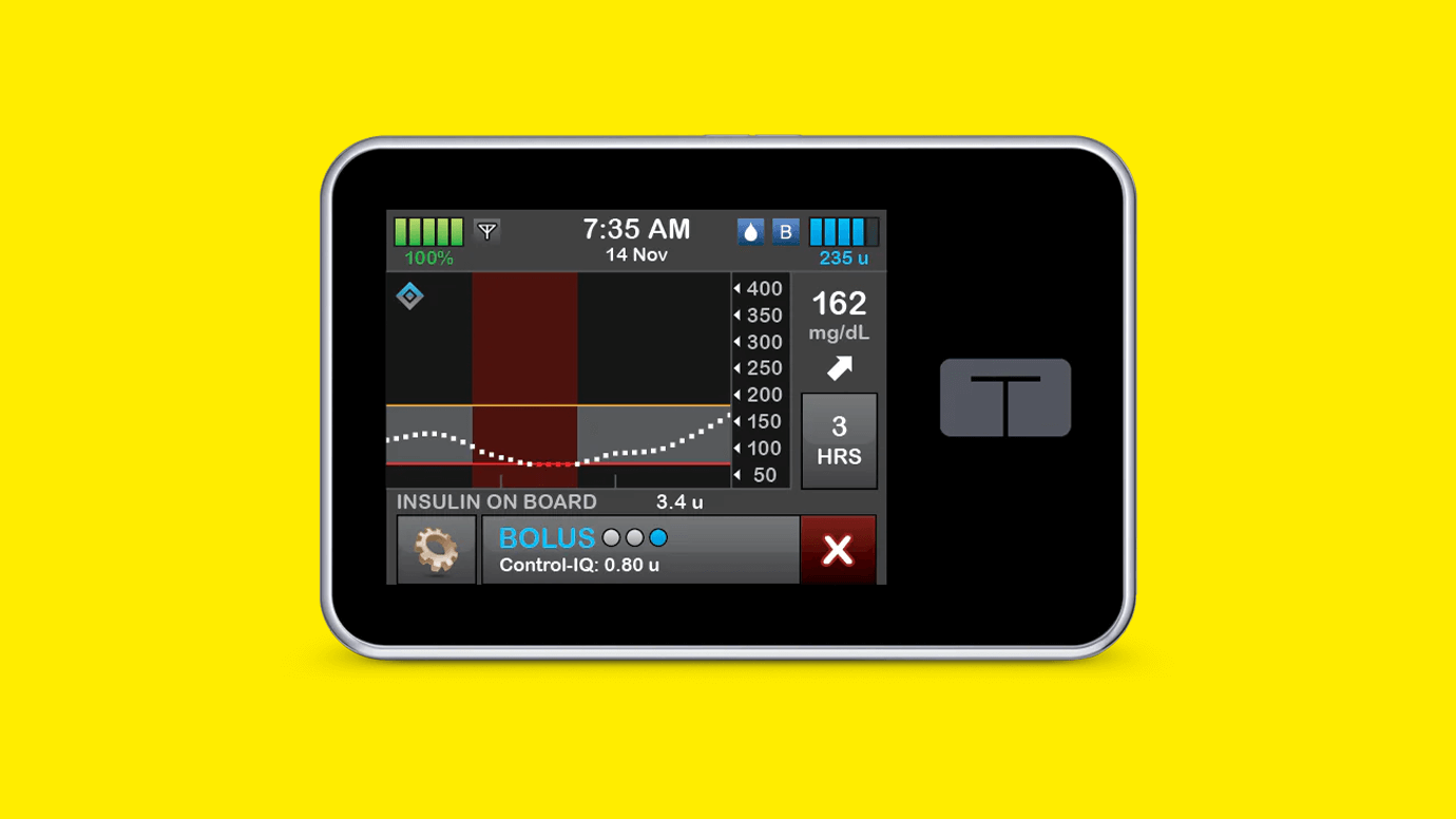 FDA Clears Tandem Insulin Pumps' Control-IQ+ for People With Type 2 Diabetes